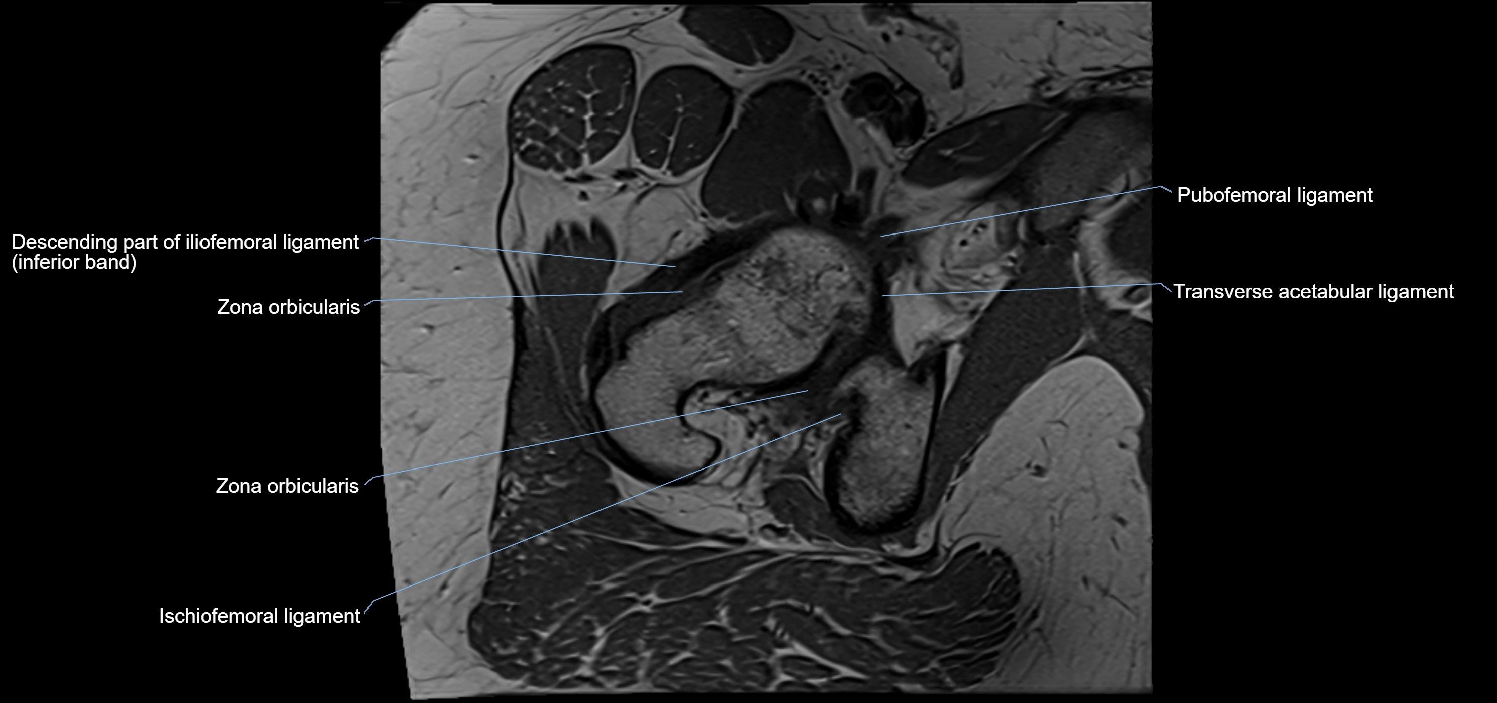 Hip ligament anatomy axial 3T MRI image -img-13001-00020.webp